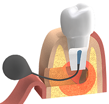 Der Wurzelkanal wird gereinigt und bakteriendicht verschlossen.