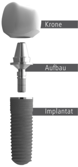 Ein Zahnimplantat besteht aus einer Krone, Aufbau und dem eigentlichen Implantat.