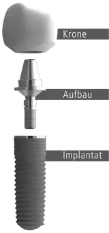 Implantataufbau mit Implantatschraube, Implantataufbau und Krone.