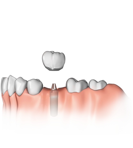 Wie ein Implantat gesetzt wird, wenn nur ein Zahn fehlt, sehen Sie hier.