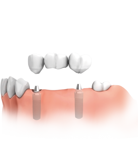 Zahn-Implantate mit Brücken können mehrere fehlende Zähne ersetzen.