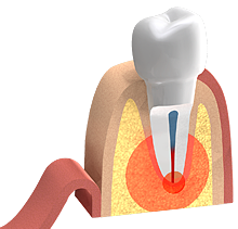 Das Öffnen des Zahnfleisches, grafisch dargestellt.