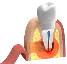 Das Freilegen der Zahnwurzel in der Kieferchirurgie.