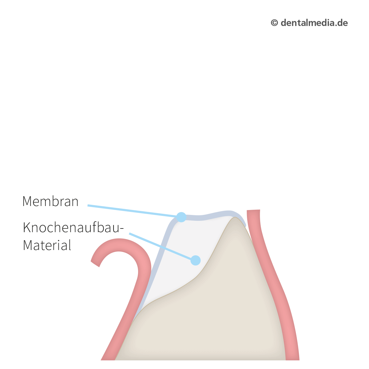 Knochenaufbaumaterial wird eingesetzt, danach folgt der Verschluss mit einer Membran.