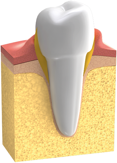 Zahnfleisch-Entzündung: das Zahnfleisch ist gerötet und geschwollen.
