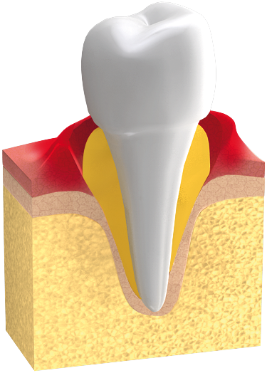 Parodontitis führt zu einem Verlust an Knochensubstanz und einer Lockerung der Zähne.
