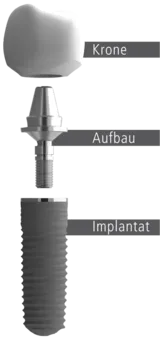 Implantataufbau mit Implantatschraube, Implantataufbau und Krone.